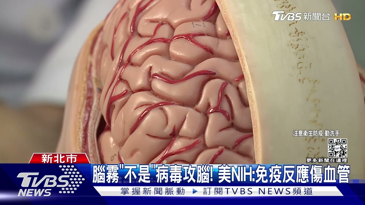 腦霧「不是」病毒攻腦！　美NIH：免疫反應傷血管