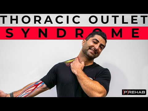 Exercises for Thoracic Outlet Syndrome