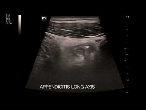 RLQ Abdominal Pain in 15 y.o. Male: Mindray TE-X Appendicitis scanning