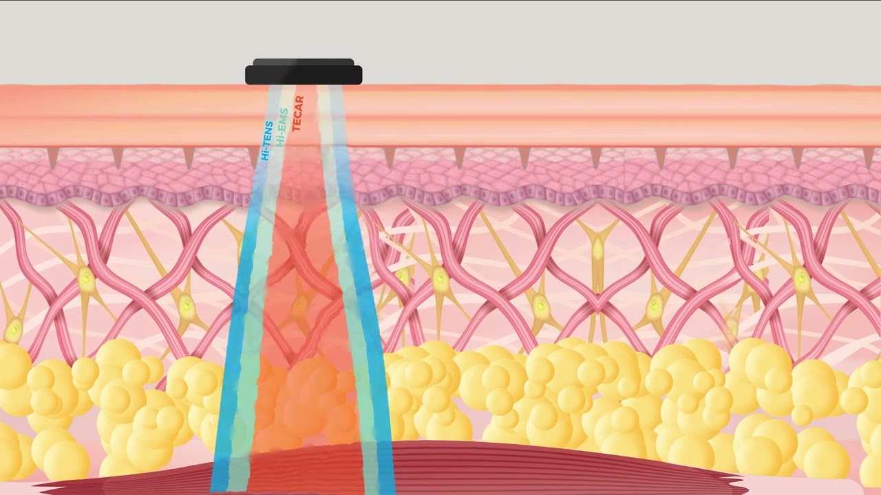 NeoCare Advanced, l'appareil de radiofréquence Anti-âge & Minceur - Bloomea