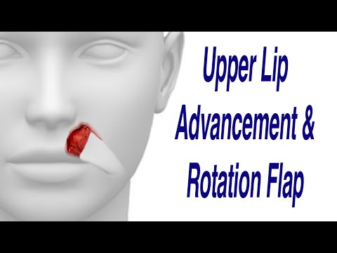 Upper Lip Cancer Excision with Advancement & Rotation Flap Reconstruction
