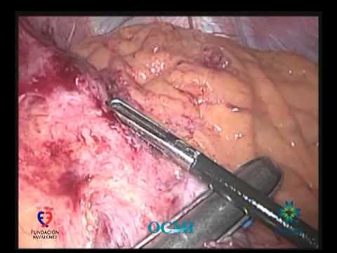 Laparoscopic Sleeve Gastrectomy Conversion To Laparoscopic Roux En-Y Gastric Bypass