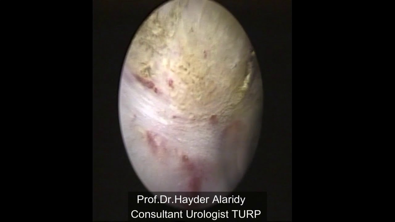 TURP prostate تجريف بروستات بالناظورد.حيدر العارضي