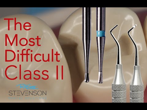 The Most Challenging Class II Amalgam Preparation - Columbia #4 DO
