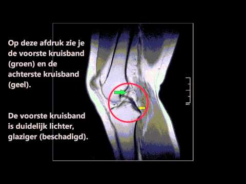 Tabletten für Schmerzen im Halsbereich Hernie gestörte Band Foramen c6 c7