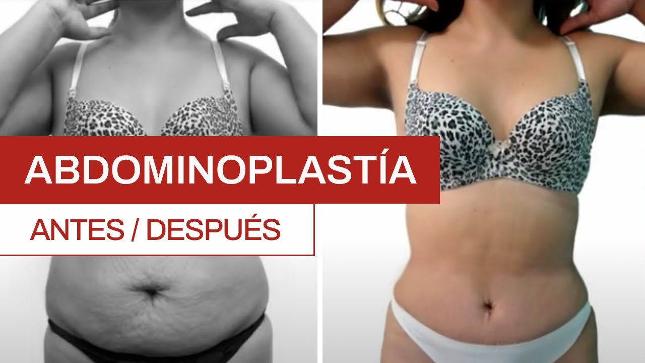 Abdominoplastía: antes y después | Clínica Barrenechea