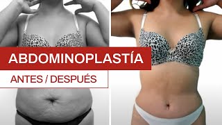 Abdominoplastía: antes y después | Clínica Barrenechea