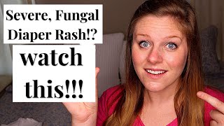 How to Cure SEVERE Diaper Rash FAST *WITHOUT PRESCRIPTION CREAMS*