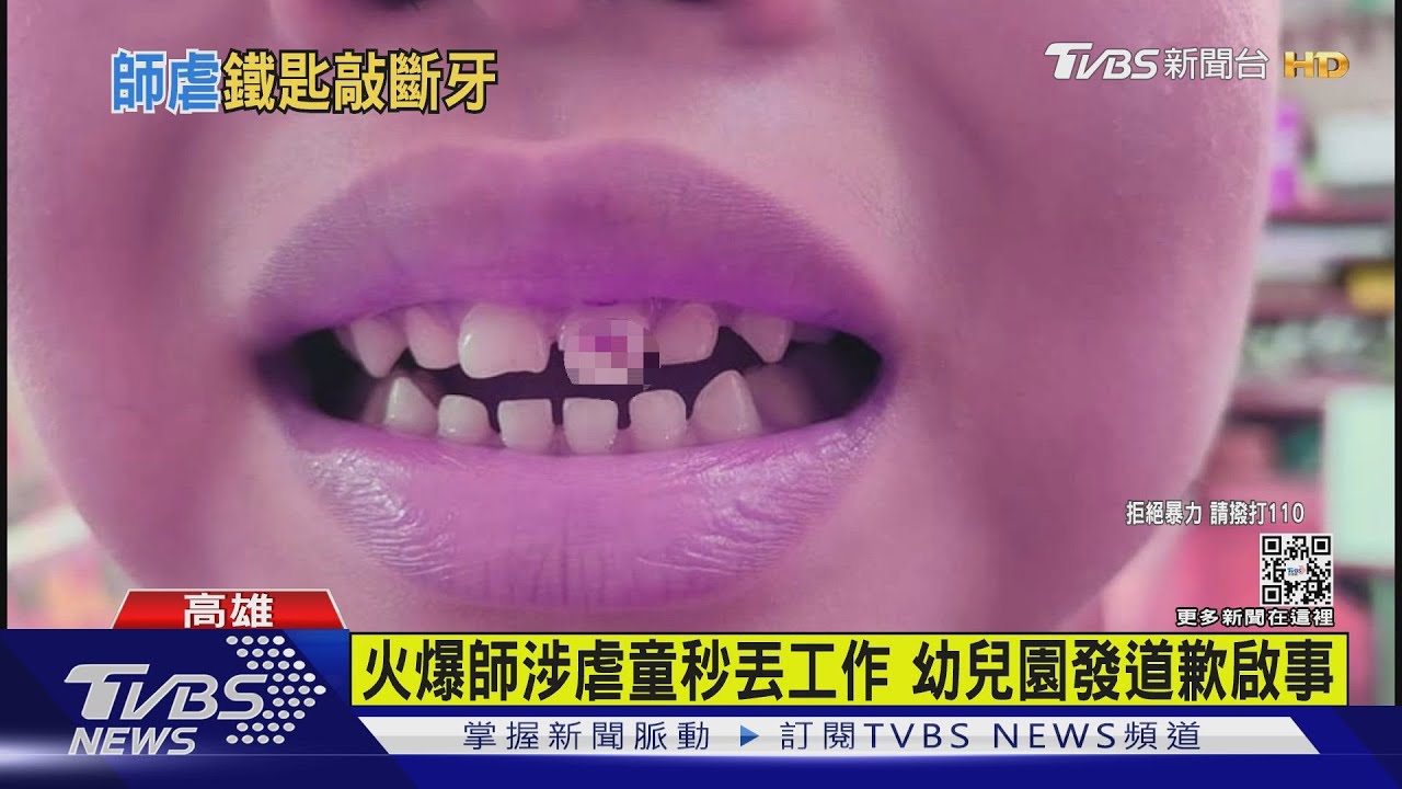 怒!女師遭控不當管教 拿湯杓狂敲男童門牙斷裂