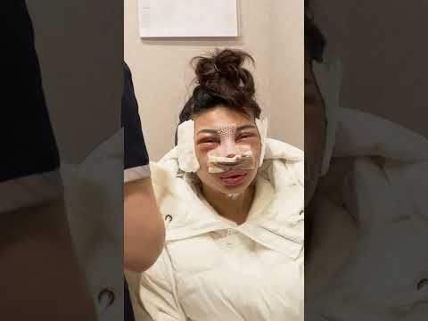 undergoing a facial contouring surgery in korea😱😱😱