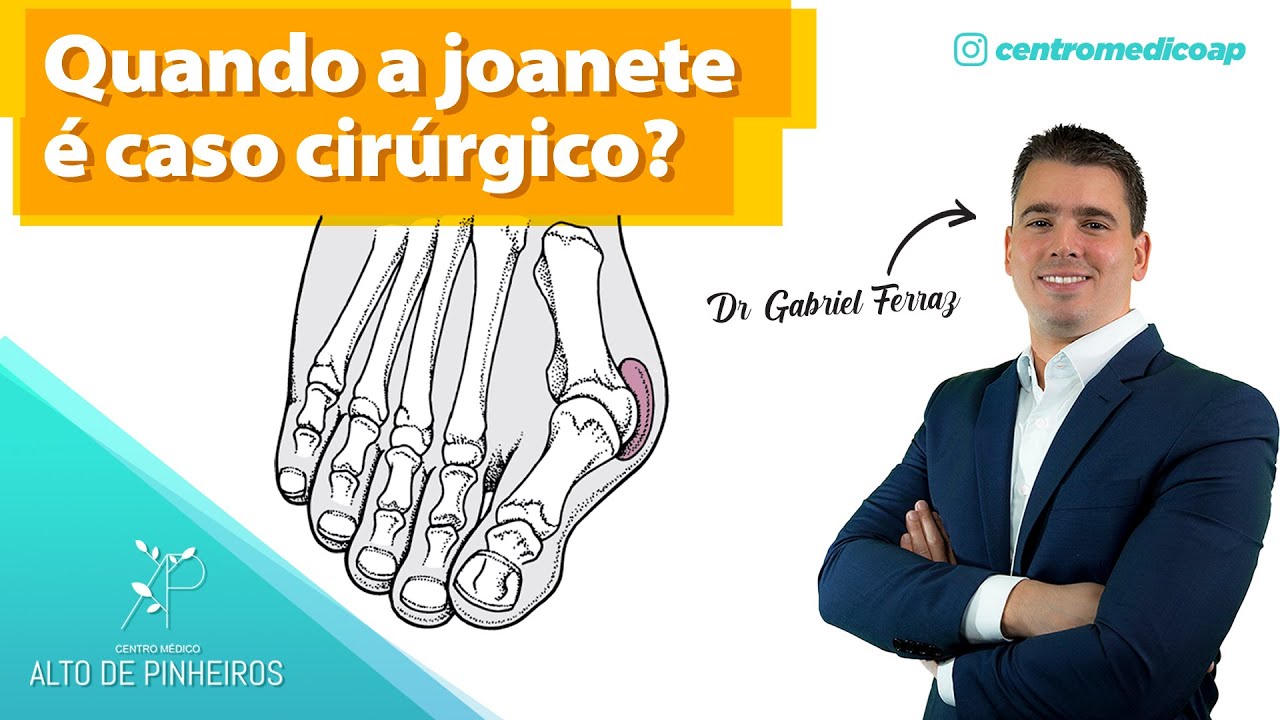 Como IDENTIFICAR quando a JOANETE é um caso CIRÚRGICO? | Dr. Gabriel Ferraz