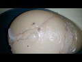 Silicone Breast Prosthesis