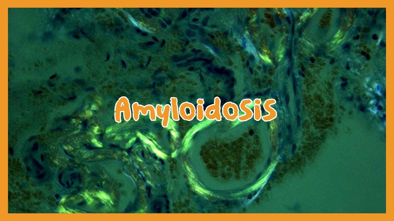Amyloidosis