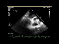 AP VALVES SH 2019 Live Case Lecture 2 TAVR 4