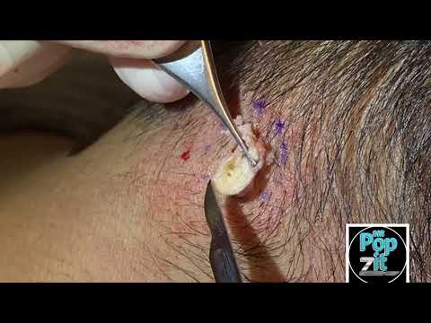 Firmly packed neck cyst. Big squeeze and pop. Full cyst excision and closure. MrPopZit.