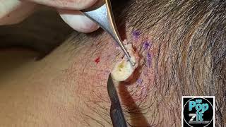 Firmly packed neck cyst. Big squeeze and pop. Full cyst excision and closure. MrPopZit.