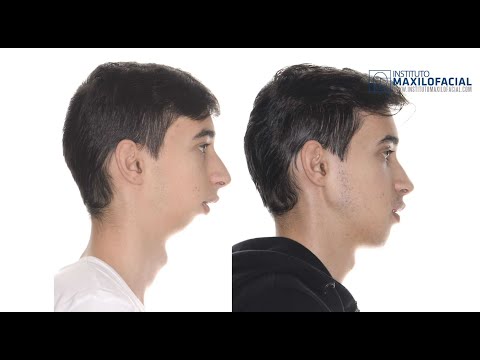 download lagu mp3 mp4 Cirugia Ortognatica Bimaxilar Clase Ii, download lagu Cirugia Ortognatica Bimaxilar Clase Ii gratis, unduh video klip Cirugia Ortognatica Bimaxilar Clase Ii