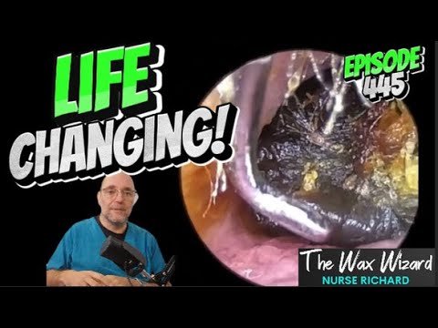 LIFE CHANGING! Episode 445 (possible keratosis obturans!)