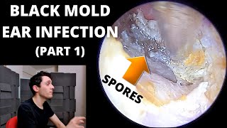 Black Mold Ear Infection Cleaned (Part 1)