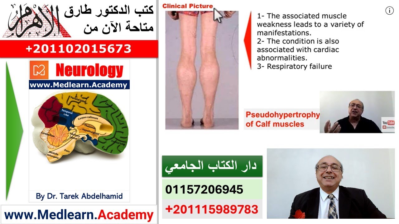 Duchenne muscular dystrophy DMD [1] #cme #internal_medicine #medicalcollege #محاضرات_باطنة