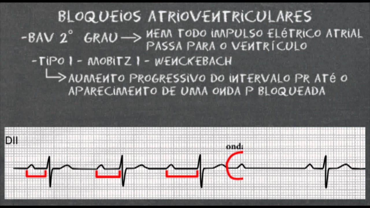 Bloqueios atrioventriculares no eletrocardiograma