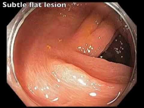 Transverse Colon - Subtle Flat Lesion
