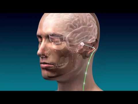 First Trial of DBS for Stroke Rehabilitation: Insights on the Underlying Science