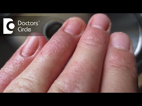 How to treat Contact Dermatitis on fingertips? - Dr. Aruna Prasad