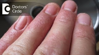 How to treat Contact Dermatitis on fingertips? - Dr. Aruna Prasad