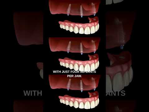 All-on-4 Dental Implants: Restore Your Smile, Confidence, and Quality of Life