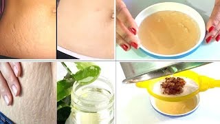 Sorirer fata dag abong Stretch mark dur korer upay || Beauty Shine Tips