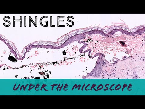 Shingles under the microscope (VZV Varicella Zoster Herpes) pathology dermpath dermatopathology