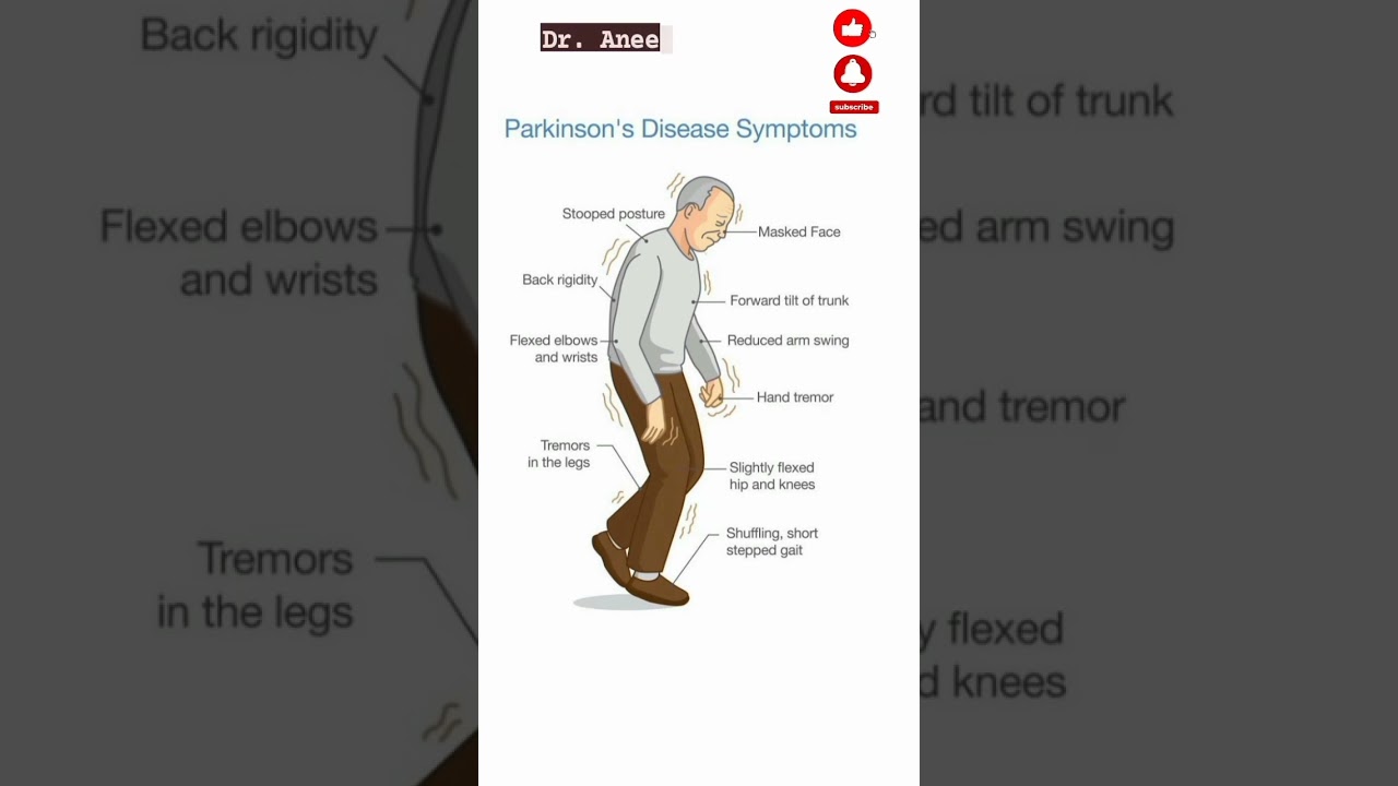 #parkinson#disease#symptoms#shorts#physiotherapy#medical#shortvideo#anatomy#short#doctors