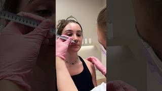 I'm done with lip fillers 🦆✂️ #LipLiftTurkey #LipSurgery #PermanentLipFlip