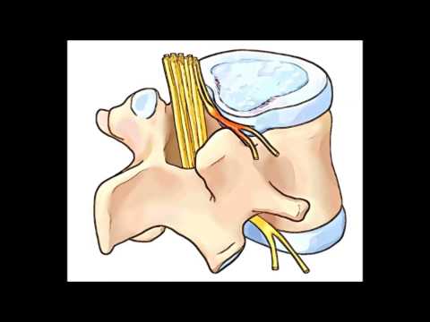 Bewegungstherapie in Osteochondrose Video torrent Osteochondrose in der Basis des Schädels
