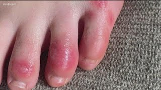 What Causes Red Itchy Bumps On Feet