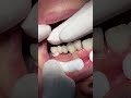 Porcelain Bridge To Replace Missing Teeth Satisfying
