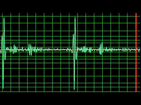 Aortic Regurgitation, Ejection Systolic Murmur- normal speed