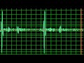 Aortic Regurgitation Ejection Systolic Murmur Normal Speed