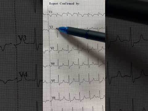 ECG - RBBB M pattern in V1 and V2 , W pattern in V5, V6