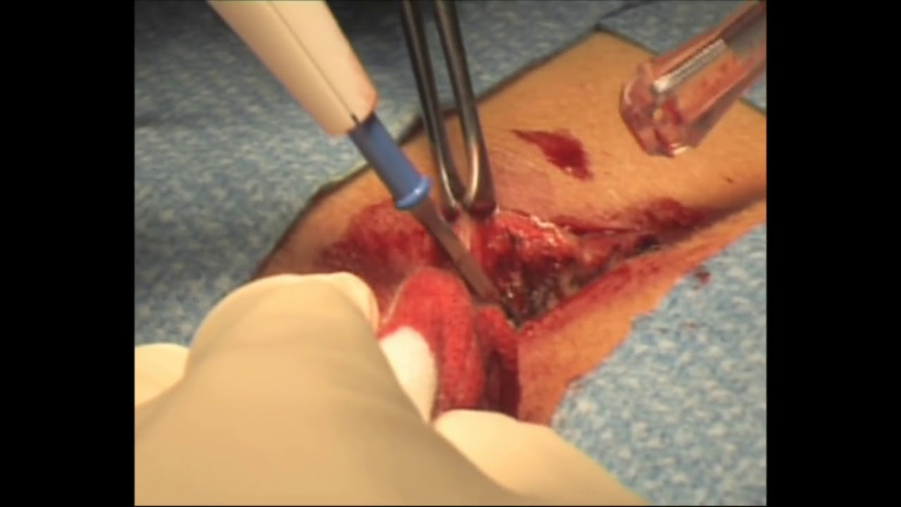 Pilonidal Sinus Excision and Primary Closure