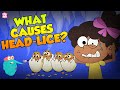 What Causes Head Lice Treatment For Head Lice The Dr Binocs Show Peekaboo Kidz