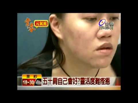 五十肩自已會好 靈活度難痊癒