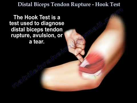 Zerwanie dystalnego ścięgna mięśnia dwugłowego ramienia – test haka