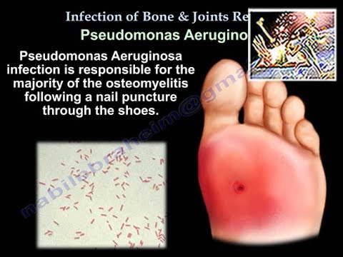 Infection of Bones & Joints, A Review - Everything You Need To Know - Dr. Nabil Ebraheim - YouTube