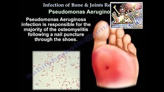 Infection of Bones & Joints, A Review - Everything You Need To Know - Dr. Nabil Ebraheim