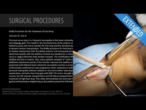 Bridle Procedure for the Treatment of Foot Drop - Extended (Feat. Dr. Johnson)