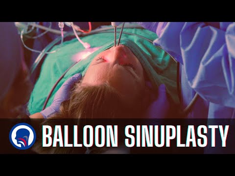 Balloon Sinuplasty Procedure | Capital ENT & Sinus Center