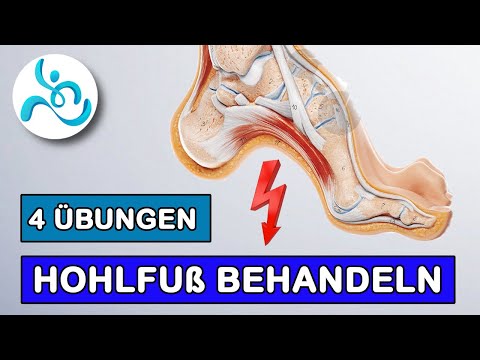 Treating hollow foot | 4 exercises for at home