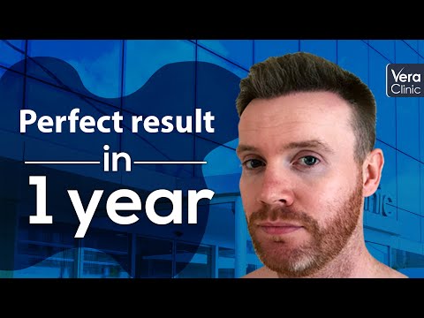 The Perfect Hair Transplant Result of Dean O'Connor -...